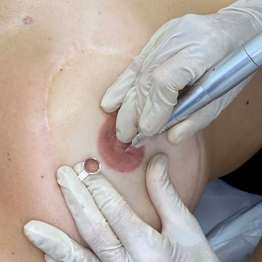tecnico-especialista-en-micropigmentacion-ongologica
