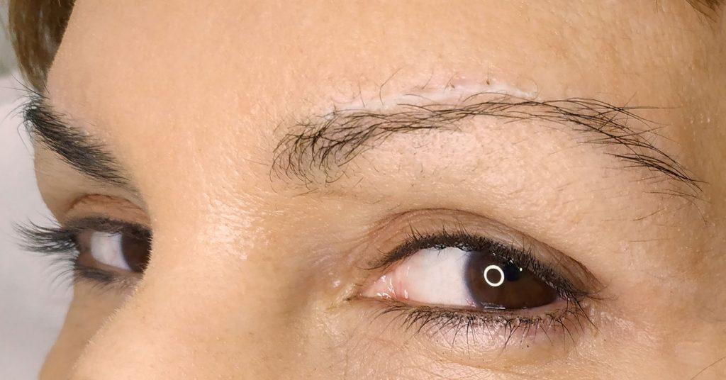Camuflaje Cicatrices Con Micropigmentación | Omicroart