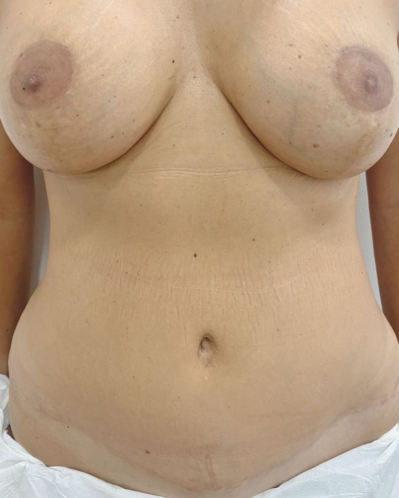 camuflaje-de-cicatrices-areolas-y-abdominoplastia