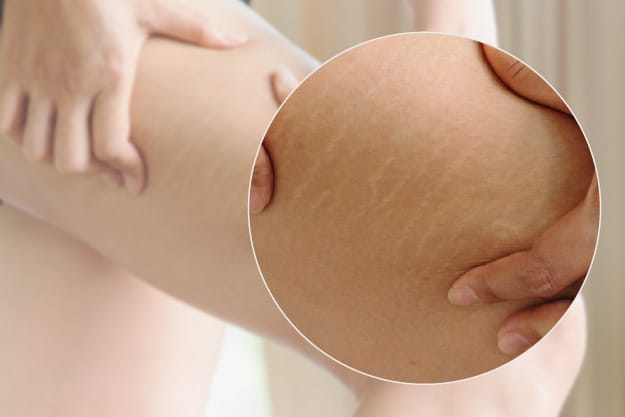 micropigmentación para mejorar las estrías