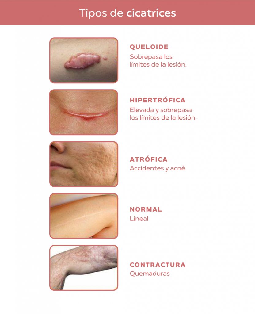 No solamente existen las cicatrices queloides e hipertróficas, hay otras variaciones.