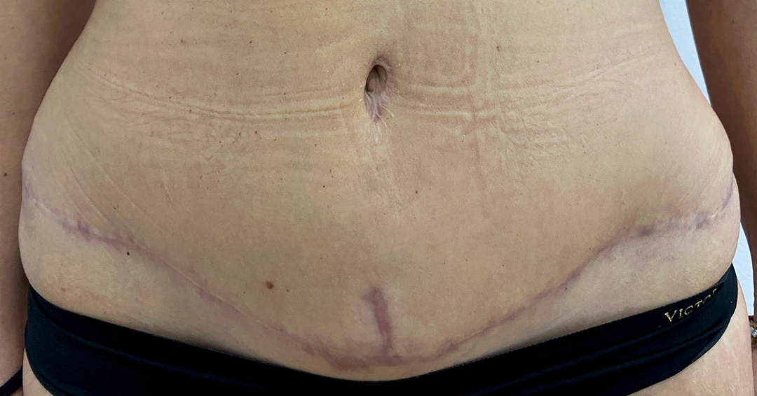 camuflaje-de-cicatrices-oscuras