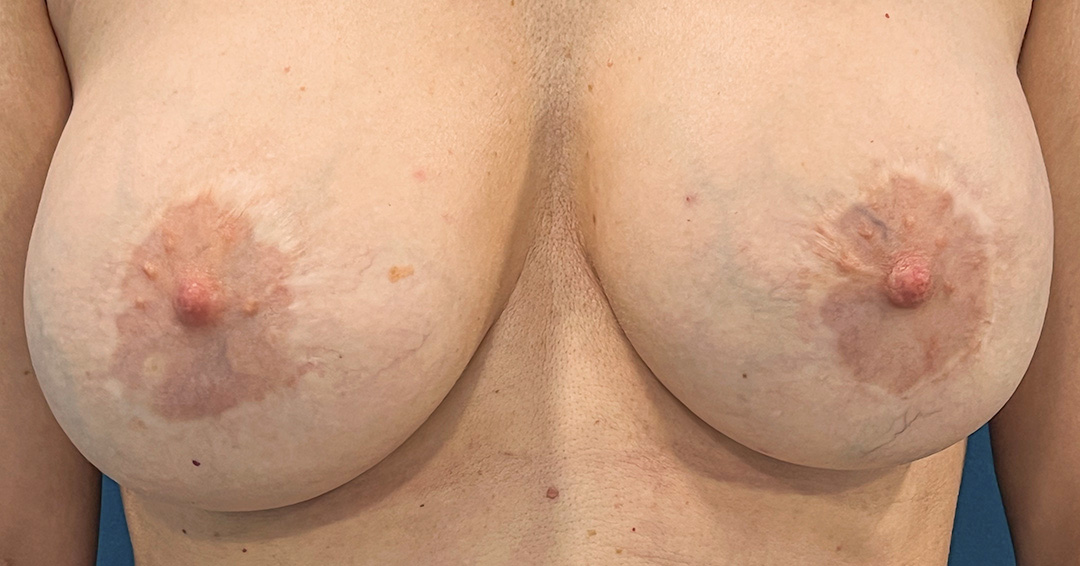 camuflar-cicatrices-en-la-aureola camuflar-cicatrices-en-la-aureola