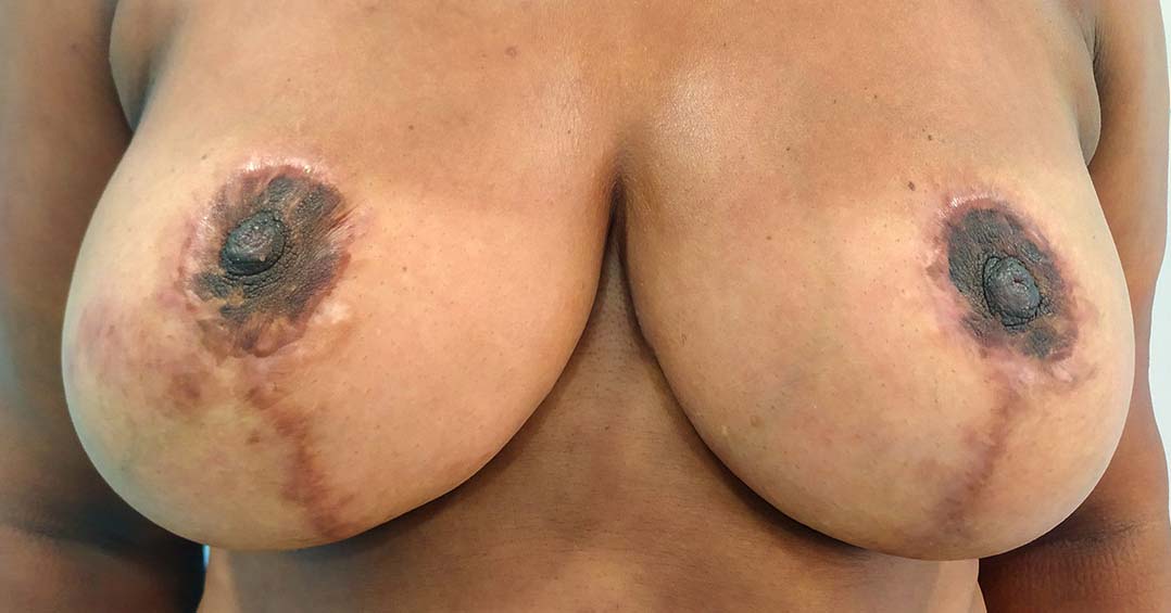 camuflage-de-cicatrices-postquirurgicas-en-arelas