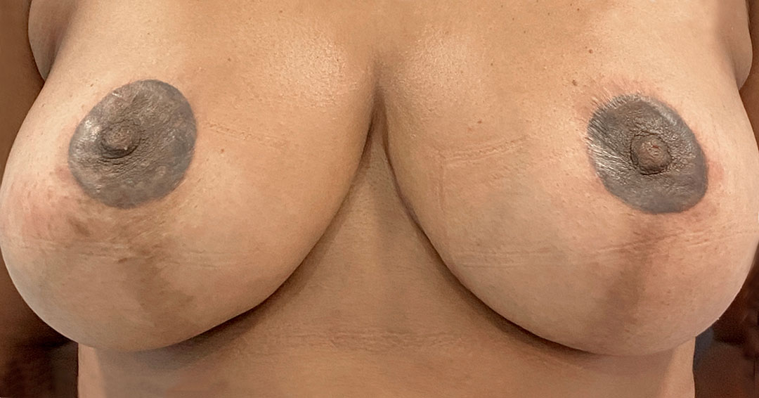 Detalle de micropigmentación paramédica en cicatriz periareolar