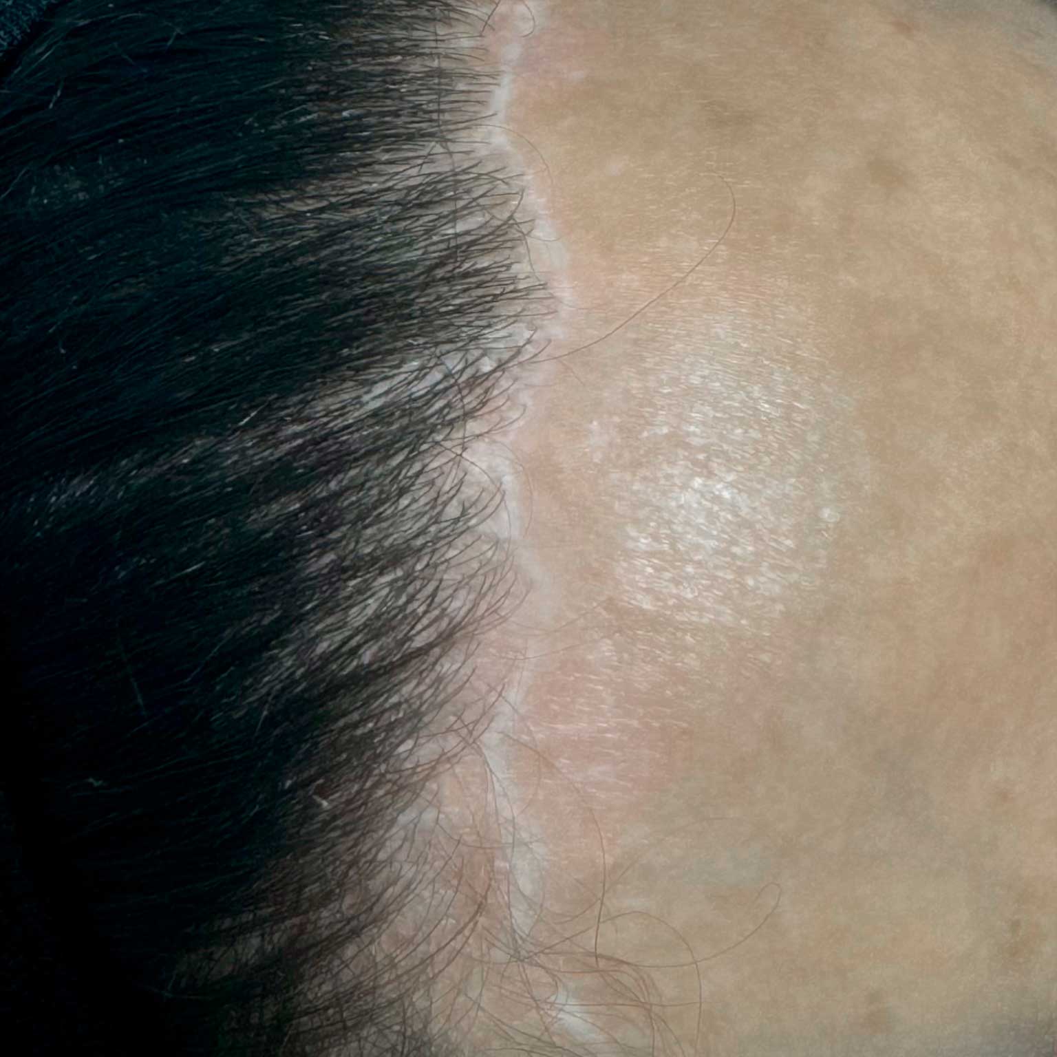 camuflaje-cicatric-frontoplastia-en-barcelona.jpg camuflaje-cicatric-frontoplastia-en-barcelona.jpg