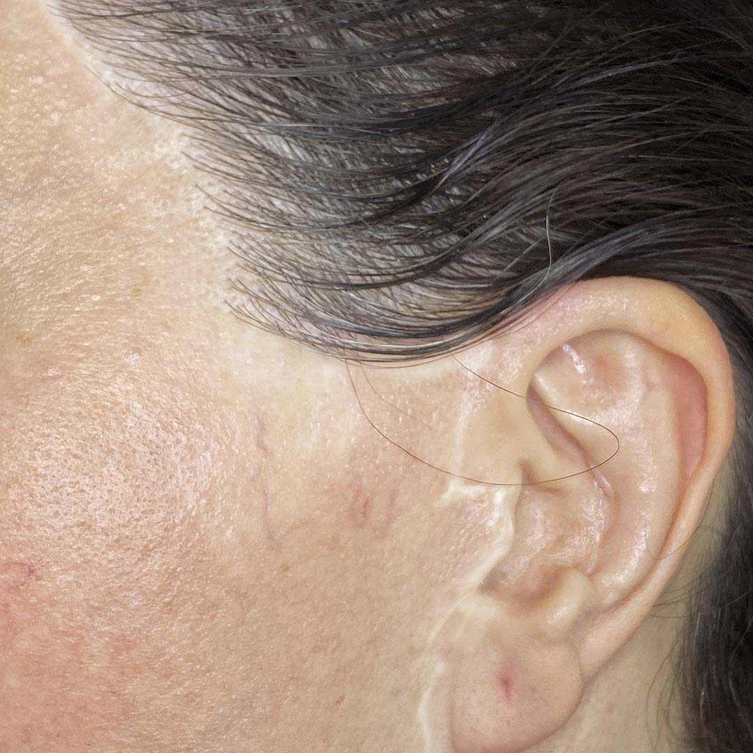 camuflar-cicatrices-de-lifting-facial.jpg camuflar-cicatrices-de-lifting-facial.jpg