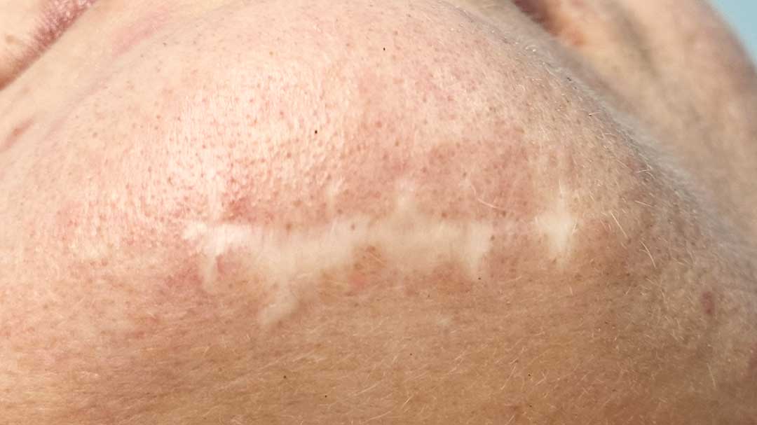 como-camuflar-una-cicatriz-en-la-barbilla.jpg como-camuflar-una-cicatriz-en-la-barbilla.jpg