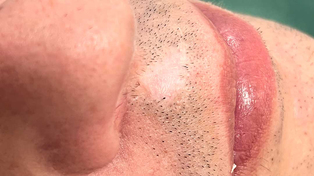 como-tapar-cicatriz-en-el-bigote-de-manera-permanente.jpg como-tapar-cicatriz-en-el-bigote-de-manera-permanente.jpg