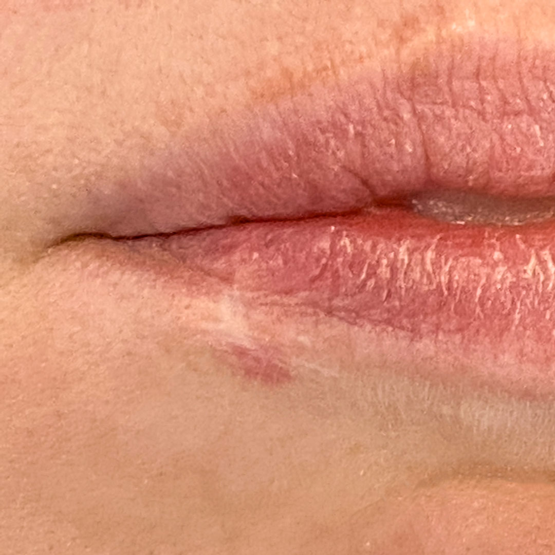 disimimular-cicatrices-en-la-boca.jpg disimimular-cicatrices-en-la-boca.jpg