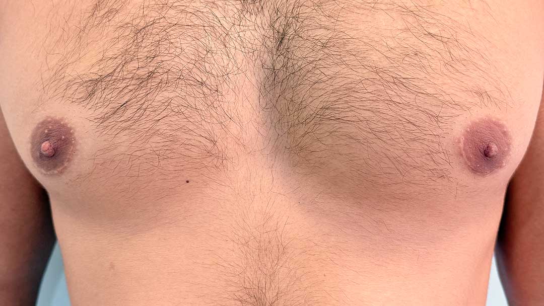 disimular-cicatrices-en-el-pecho-tras-ginecomastia.jpg