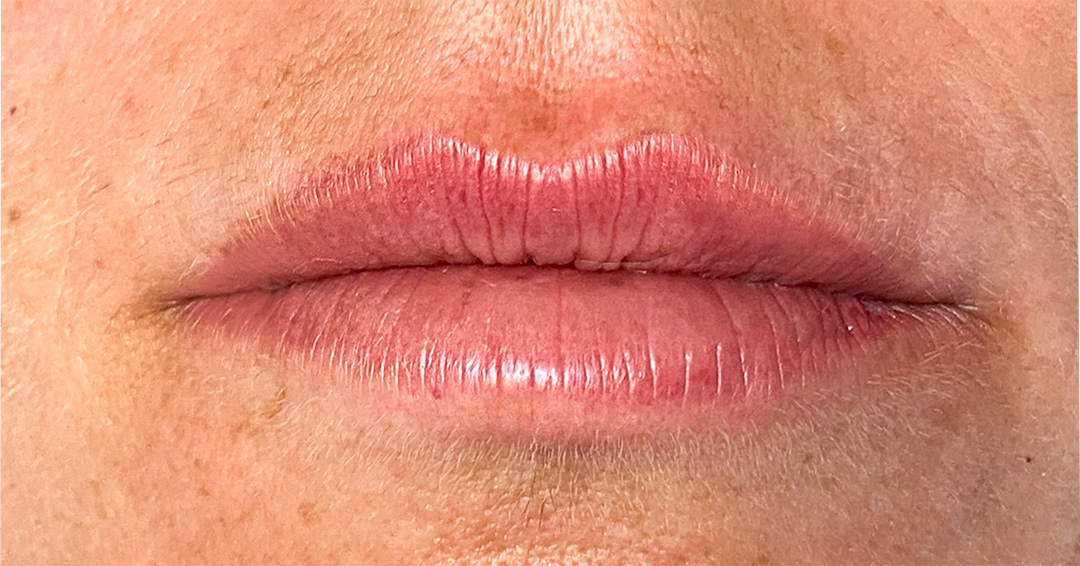 disimular-cicatrices-en-los-labios-2.jpg