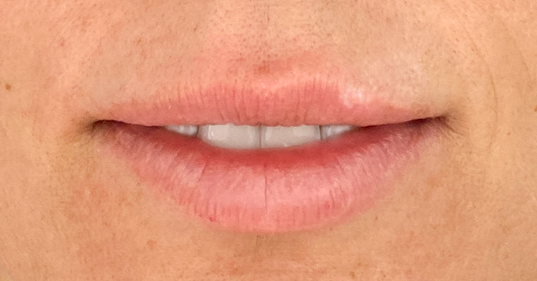 disimular-cicatrices-en-los-labios.jpg disimular-cicatrices-en-los-labios.jpg