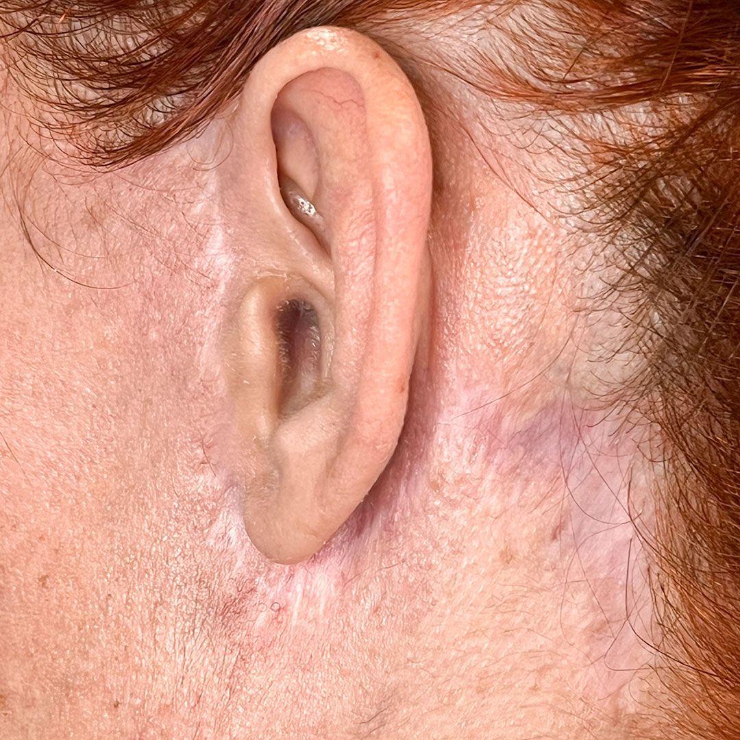 disimular-cicatrices-lifting.jpg disimular-cicatrices-lifting.jpg