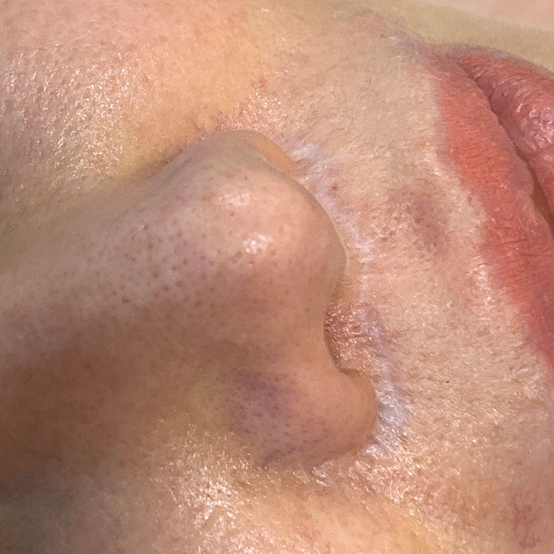 disimular-cicatriz-de-la-nariz.jpg disimular-cicatriz-de-la-nariz.jpg