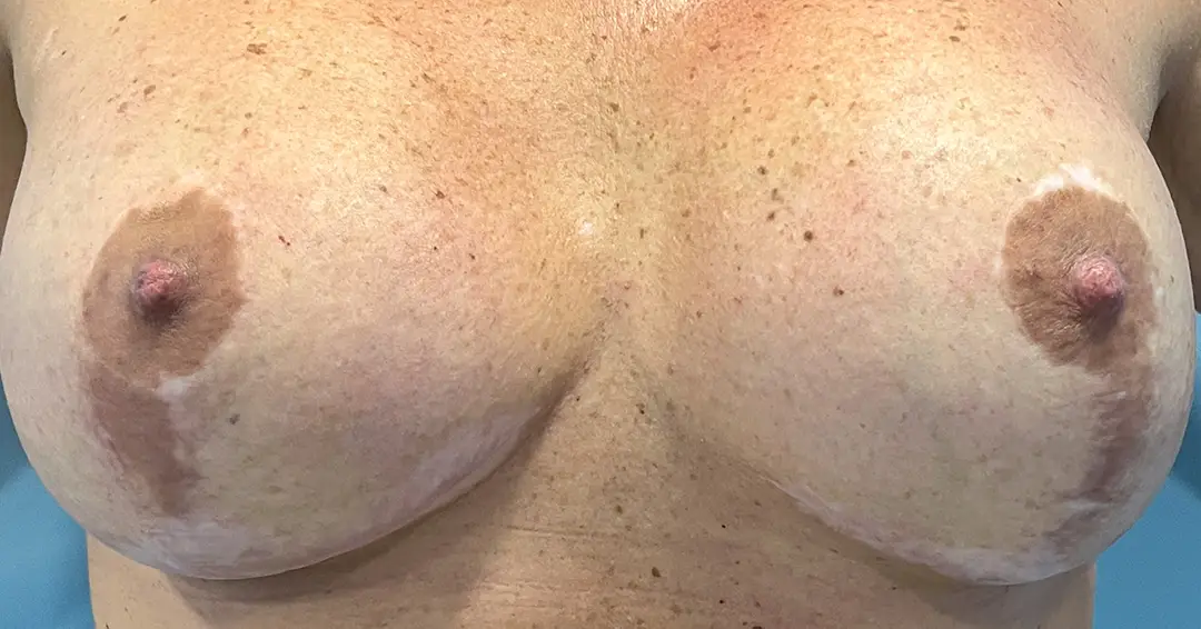 eliminar-cicatrices-oscuras-en-el-pecho