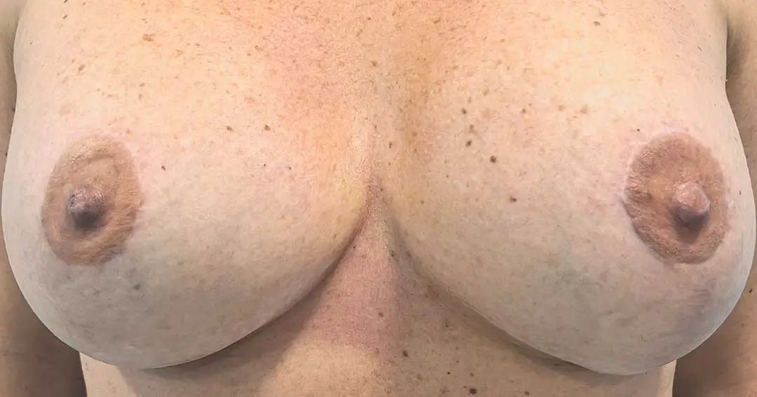 eliminar-cicatrices-oscuras-en-el-pecho-2