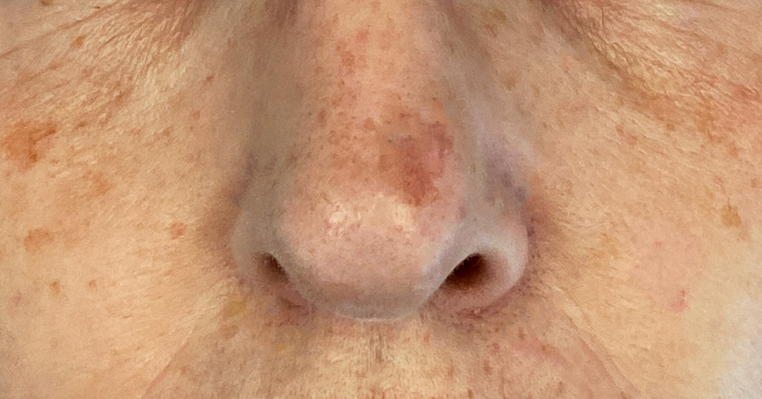 eliminar-manchas-oscuras-en-la-cara.jpg eliminar-manchas-oscuras-en-la-cara.jpg