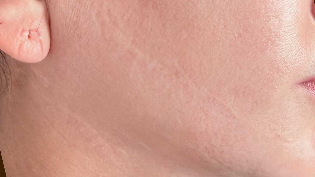 maquillaje-permanente-para-tapar-cicatrices-faciales