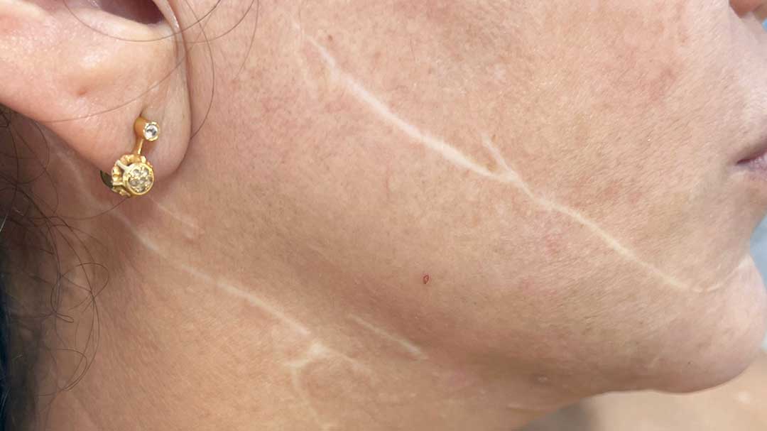 curso de camuflaje de cicatrices y Micropigmentación