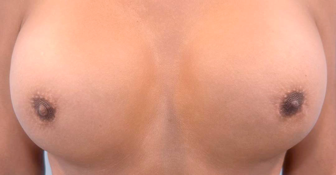 mejorar-areola-despues-de-cambio-de-sexo-barcelona.jpg