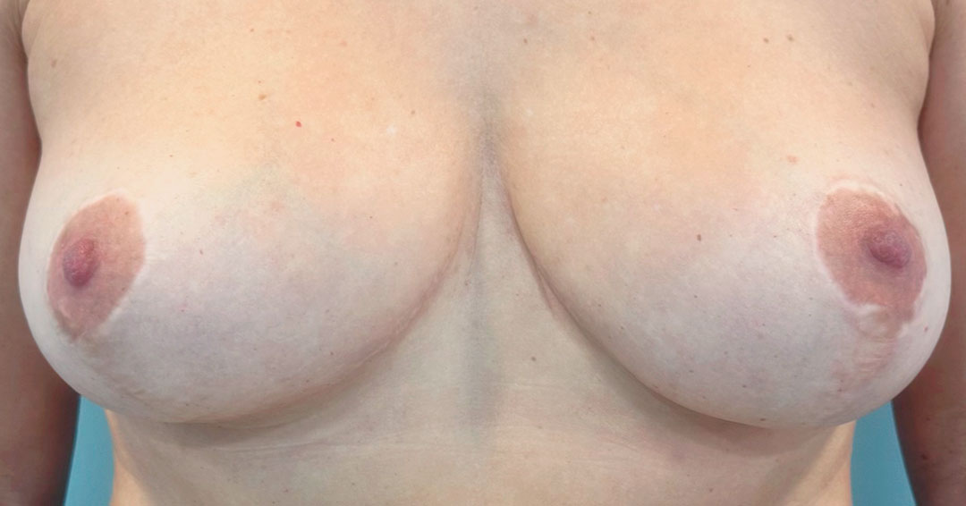 mejorar-areola-despues-de-reduccion-de-pecho-barcelona.jpg