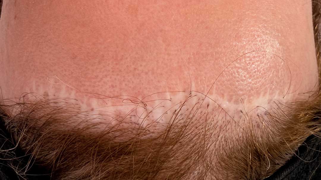 mejorar-cicatrices-tras-frontoplastia-en-barcelona.jpg mejorar-cicatrices-tras-frontoplastia-en-barcelona.jpg