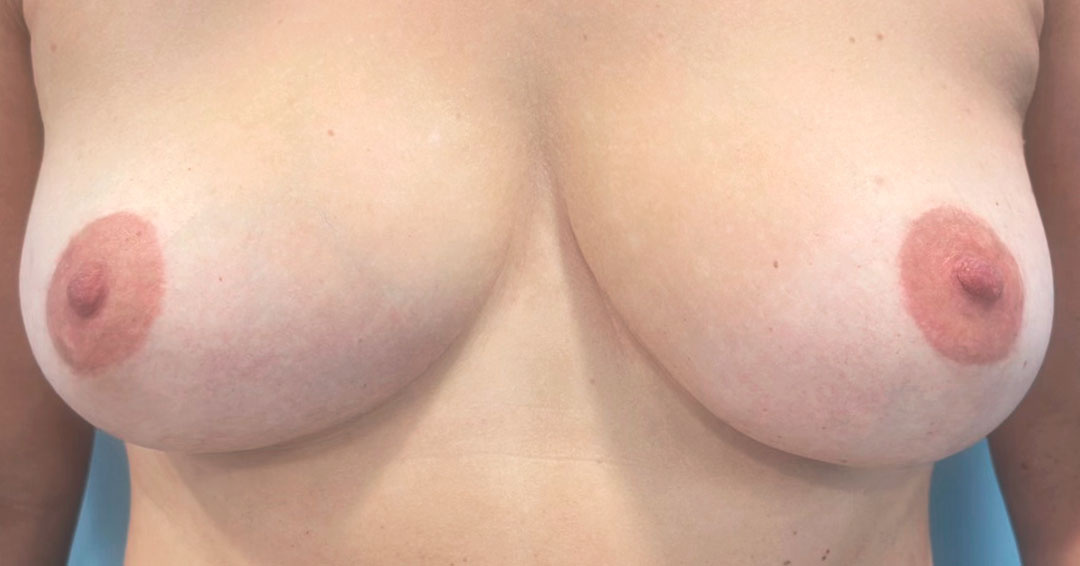 mejorar-cicatriz-despues-de-reduccion-de-pecho-barcelona.jpg