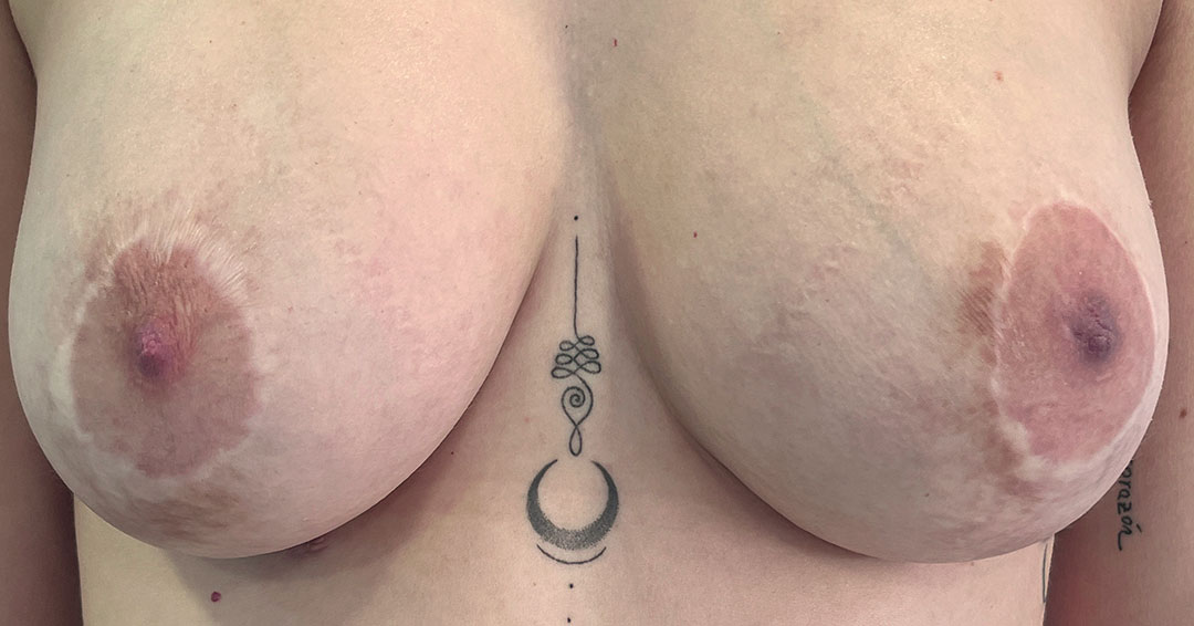 mejorar-textura-y-color-de-cicatrices-de-pecho-en-barcelona.jpg