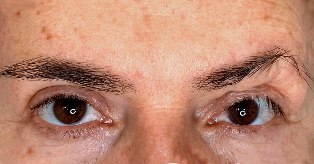 micropigmentacion-de-cicatrices-en-la-cara.jpg micropigmentacion-de-cicatrices-en-la-cara.jpg