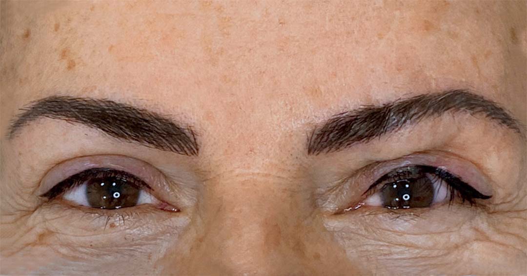 micropigmentacion-de-cicatrices-faciales.jpg