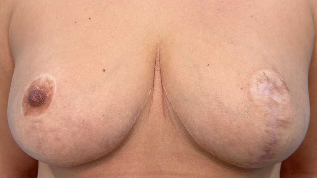 reconstruccion-de-areolas-con-micropigmentacion-antes-y-despues-en-barcelona.jpg