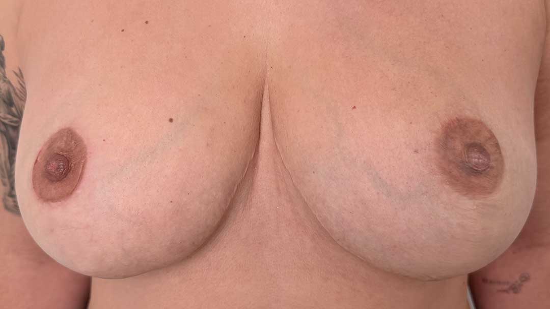 reconstruccion-de-areolas-con-micropigmentacion-antes-y-despues.jpg