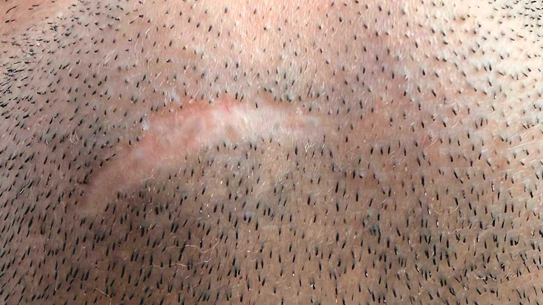 tapar-cicatriz-con-barba-de-manera-permanente.jpg tapar-cicatriz-con-barba-de-manera-permanente.jpg