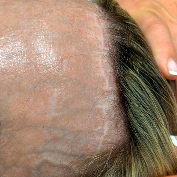 tapar-cicatriz-frontoplastia.jpg tapar-cicatriz-frontoplastia.jpg