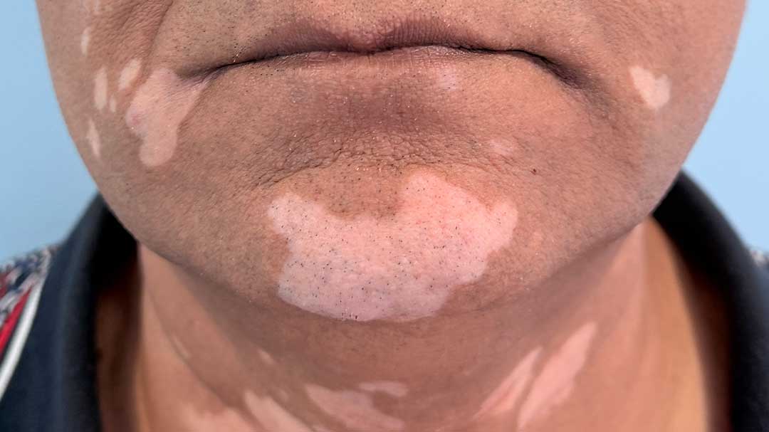 tratamiento-para-camuflar-manchas-de-vitiligo-en-barcelona