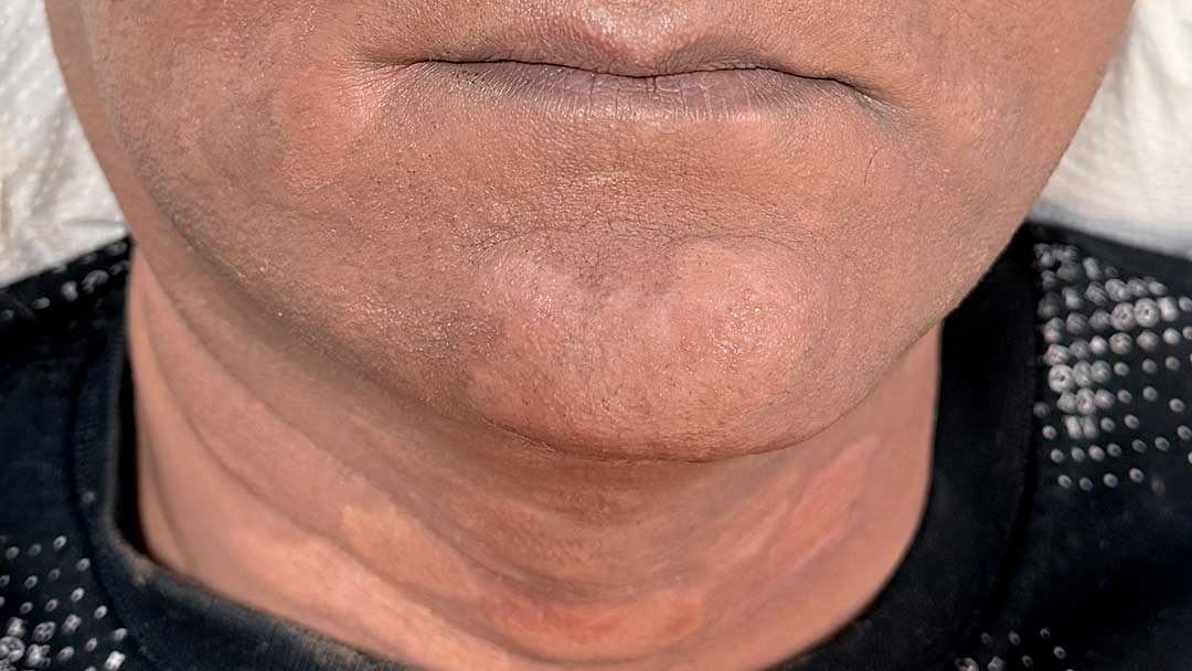 tratamiento-para-camuflar-manchas-de-vitiligo-en-tarragona
