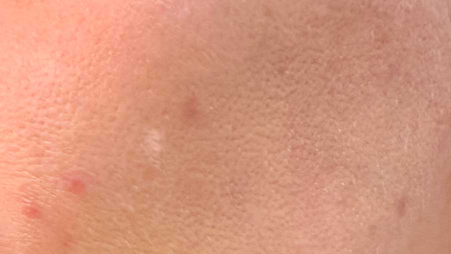 tratamiento-para-manchas-faciales-blancas-en-barcelona.jpg tratamiento-para-manchas-faciales-blancas-en-barcelona.jpg