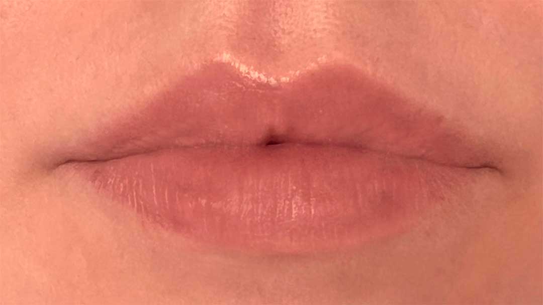 tratamientos-para-cicatrices-en-labios.jpg