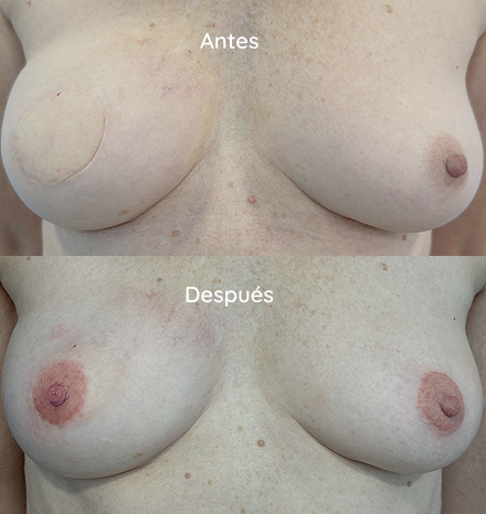 casos reales micropigmentacion oncologica