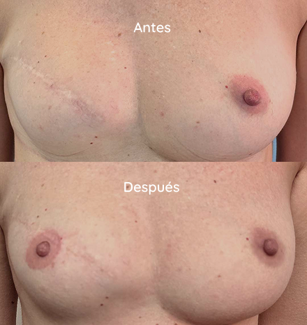 casos reales micropigmentacion oncologica