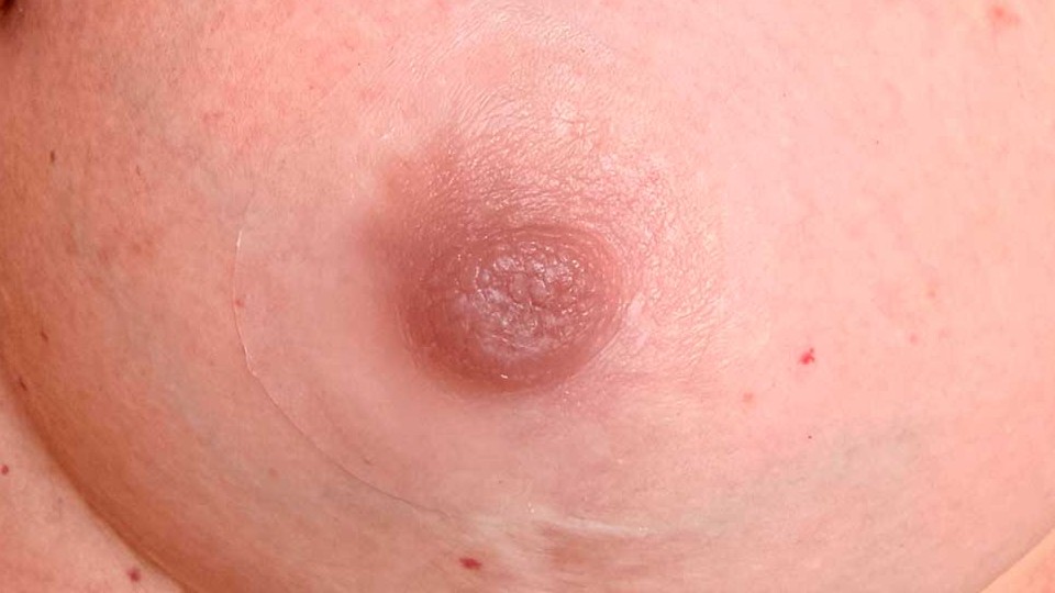 Detalle de areola protésica de silicona médica adaptada a tono de piel tras mastectomía