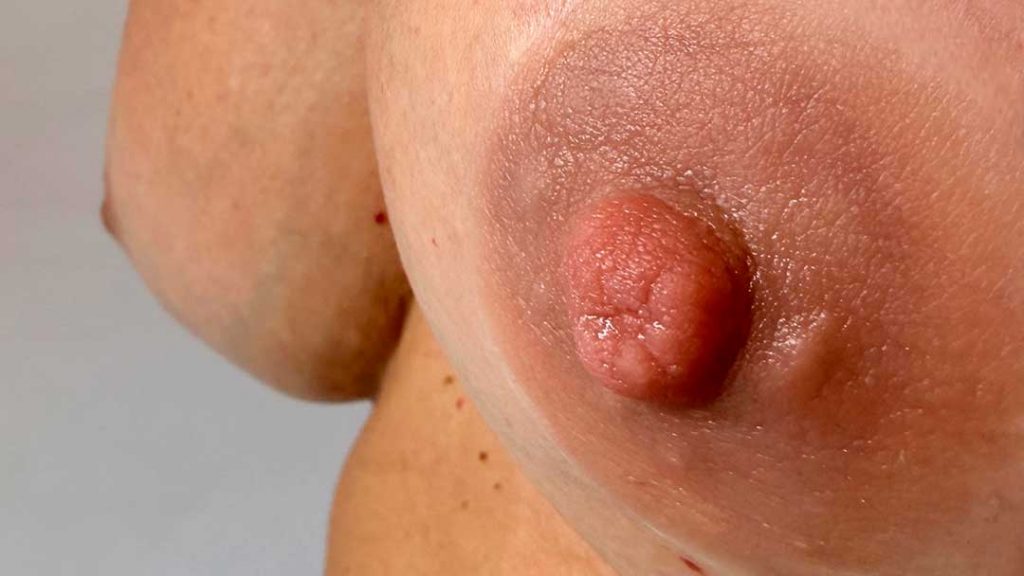Detalle de areola protésica de silicona médica adaptada a tono de piel tras mastectomía