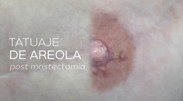 3D areola tattooing via oncological micropigmentation with a hyper-realistic effect following breast reconstruction.